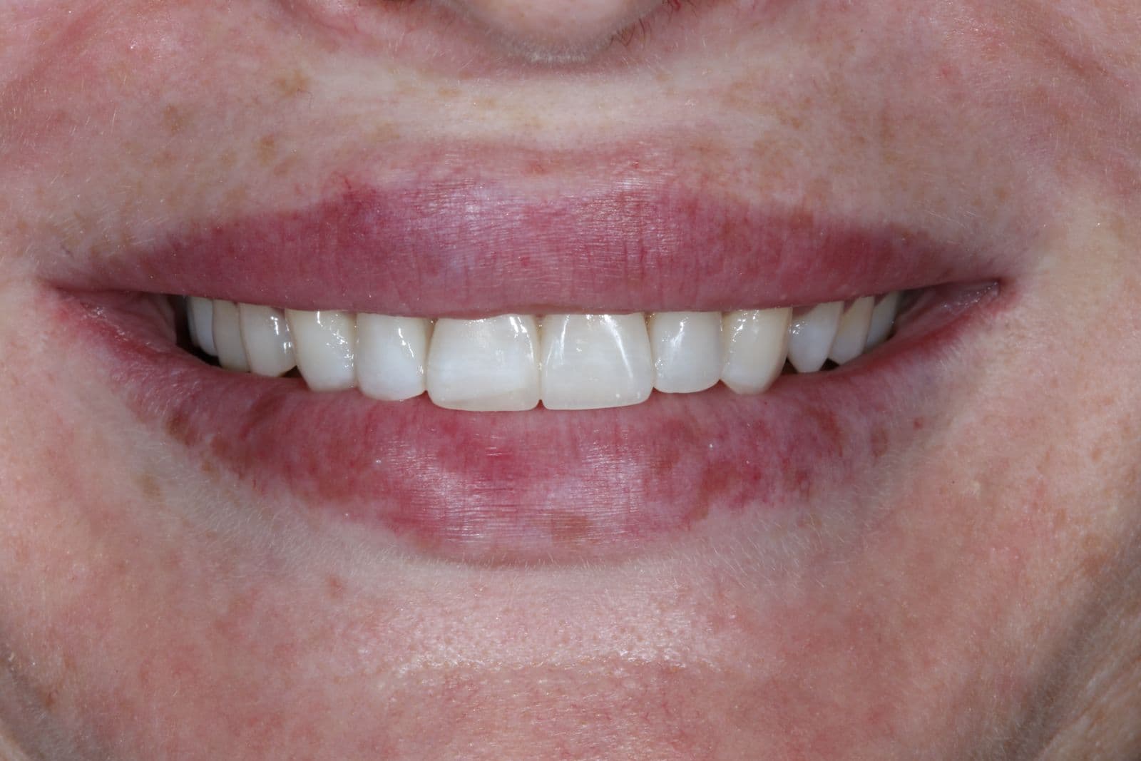 Smile makeover 1 - after