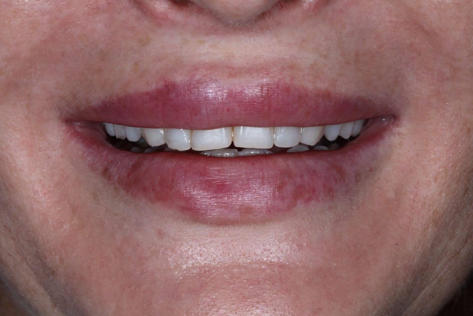 Smile makeover 1 - before