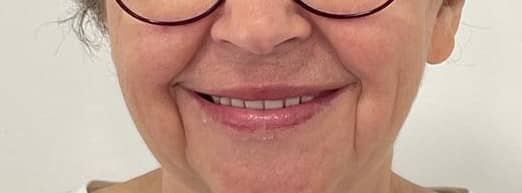 Full-arch rehabilitation case 1 after