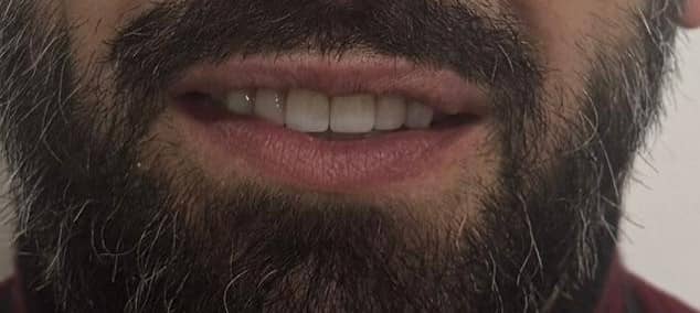 Full-arch rehabilitation case 2 after