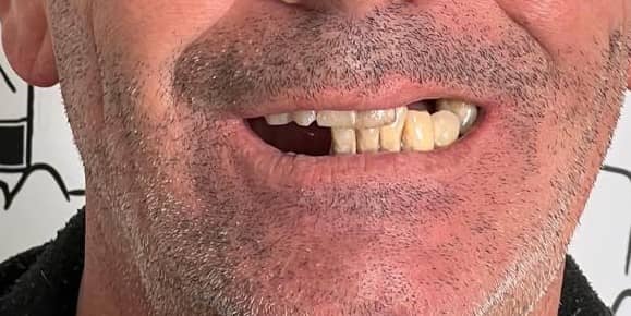 Full-arch rehabilitation case 3 before