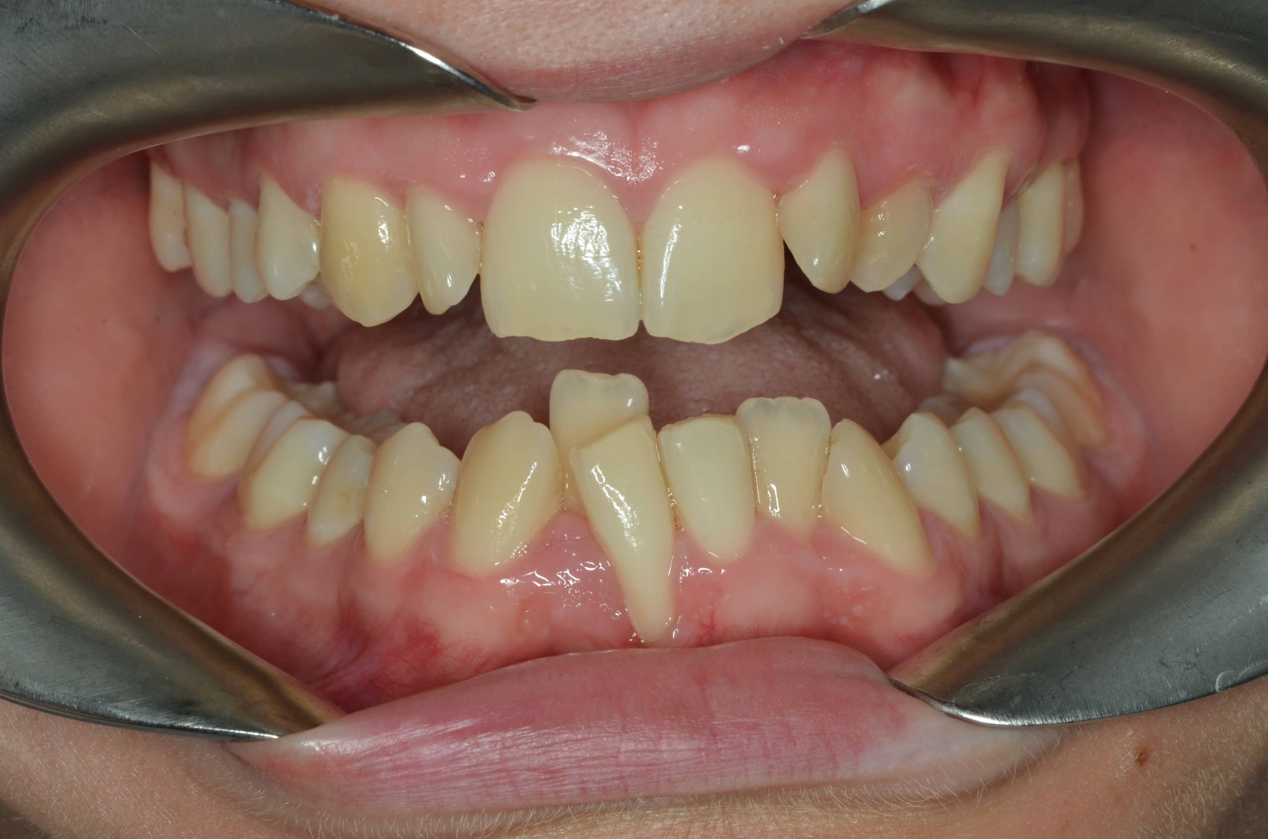 Orthodontic case 1 before