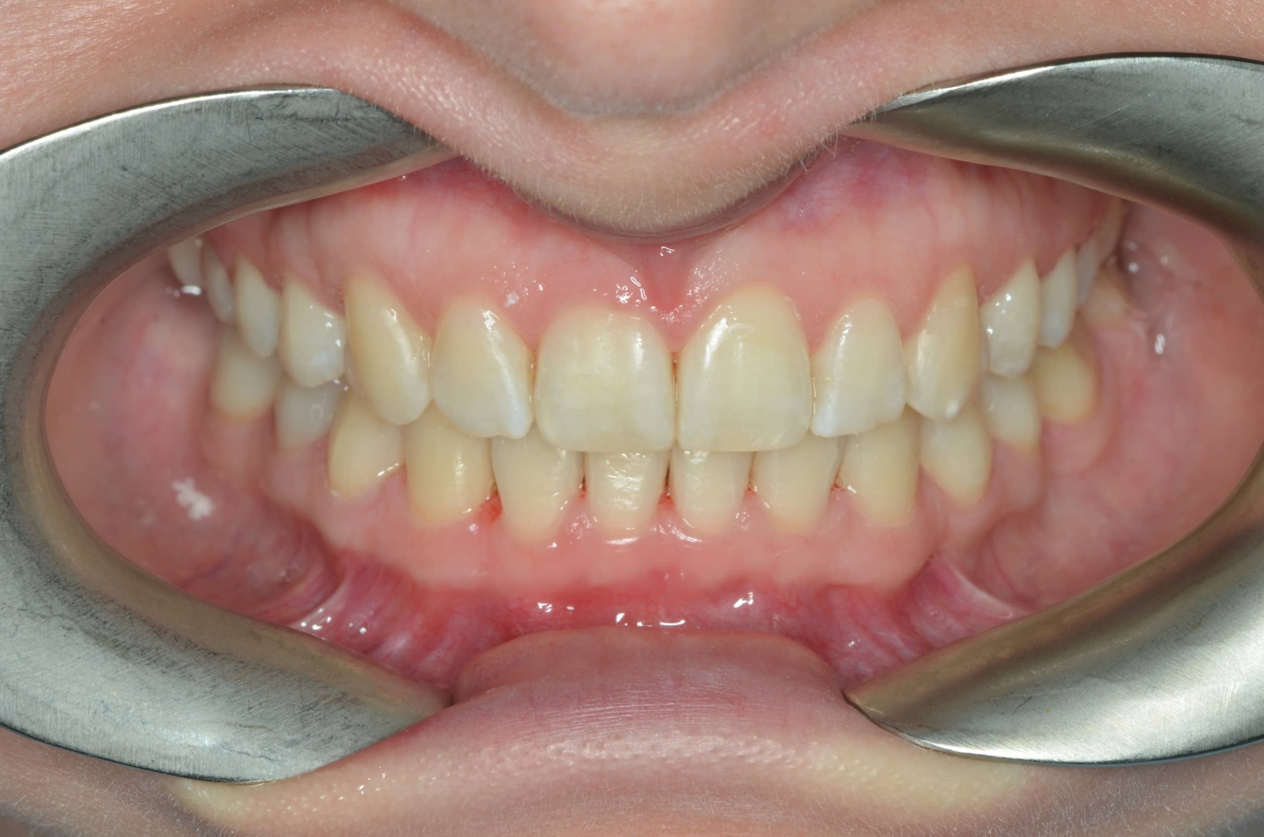 Orthodontic case 3 after