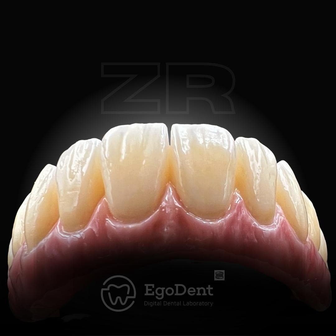 Crowns & Restorations — EgoDent Dental Clinic